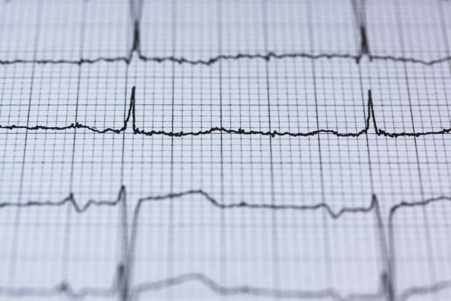 Pesquisa desenvolvida na UCPel utiliza inteligência artificial na prevenção de arritmia cardíaca